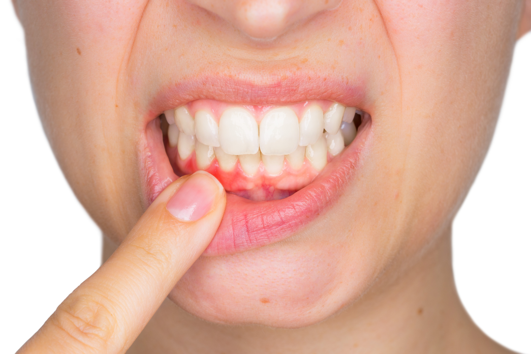 Aspirin and oral health: Can it help prevent gum disease and tooth decay?